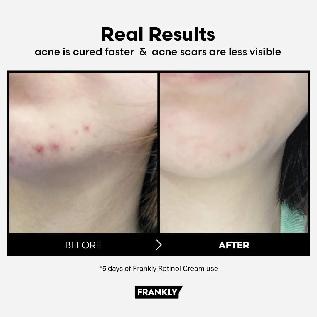[FRANKLY] Retinol 0.1 Cream 30ml